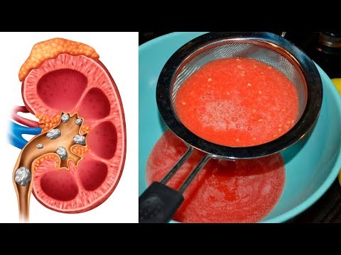 The Ultimate Recipe to Cleanse &amp; Detox Your Kidneys Naturally