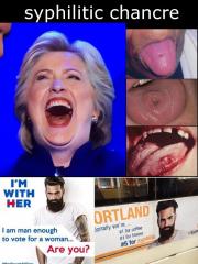 Is the spot on Hillarys Tongue Syphilitic Chancre or a Biopsy or WHAT